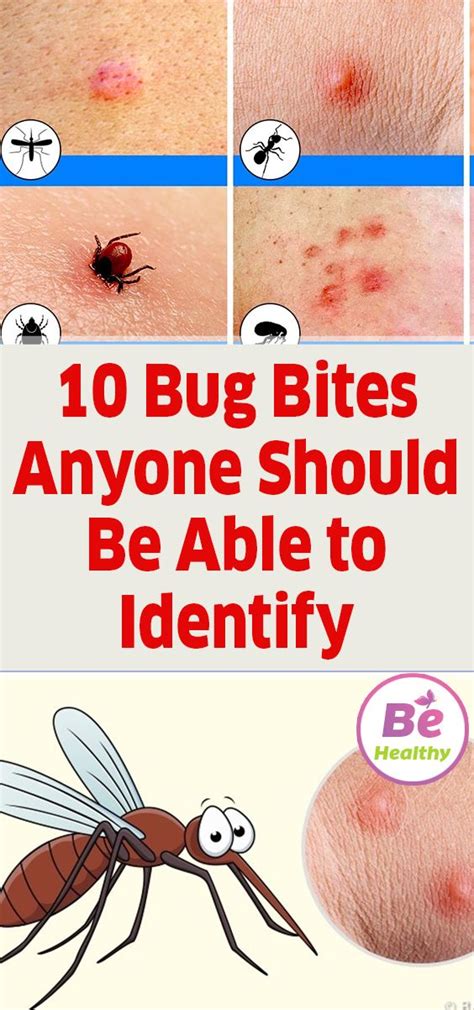 10 Bug Bites Anyone Should Be Able To Identify Insect Bites Infected