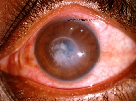 10 Corneal Ulcer Tips For Faster Healing