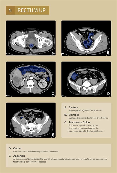 10 Ct Scan Abdomen Tips For Accurate Diagnosis