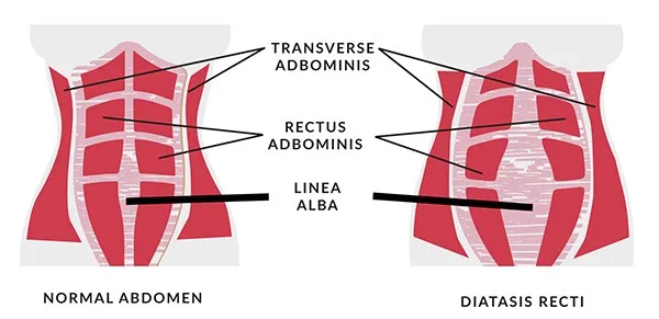 10+ Diastasis Recti Tips For Stronger Core