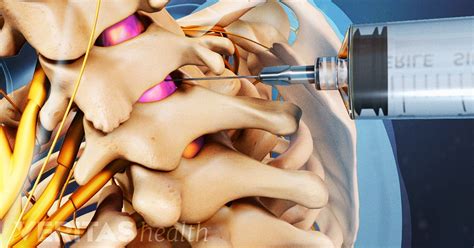 10 Esi Injections Cervical Spine Relief