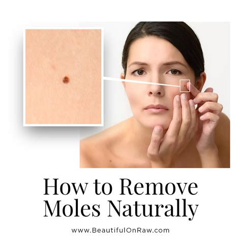 10+ Mole Removal Secrets For Smoother Skin