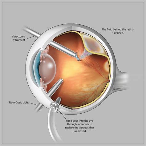 10 Retinal Detachment Recovery Tips For Faster Healing