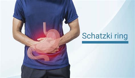 10+ Schatzki Ring Remedies For Easy Swallowing