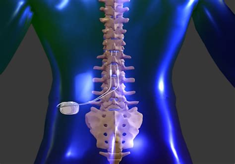 10 Spinal Cord Stimulator Tips For Pain Relief