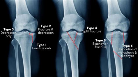 10+ Tibial Plateau Fracture Secrets For Less Pain