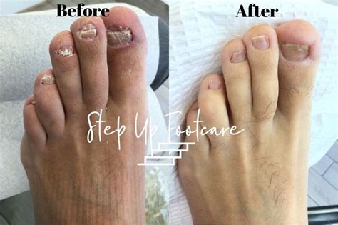 10+ Toenail Fungus Treatments With Laser Surgery Success