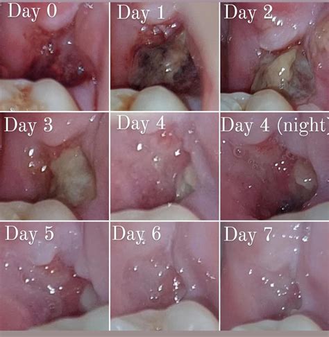 10 Tooth Removal Clot Tips For Faster Healing