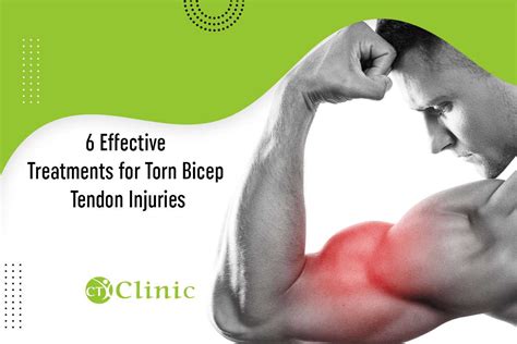 10+ Torn Bicep Remedies For Full Strength Regain