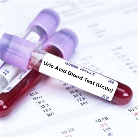 10+ Urate Test Results To Understand Your Body