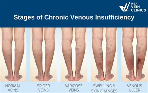 10+ Venous Insufficiency Icd 10 Tips For Accurate Billing