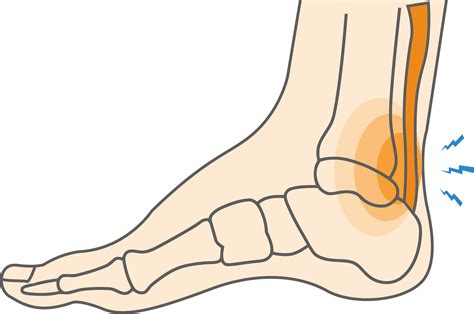 10+ Ways To Reduce Pain After Achilles Surgery