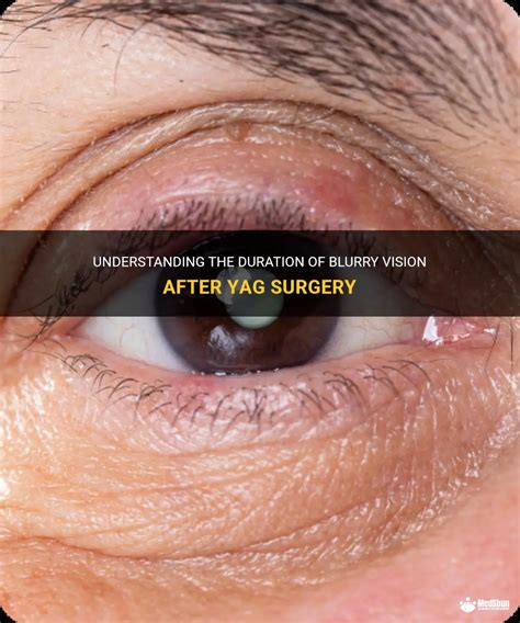 10 Yag Surgery Secrets For Better Vision