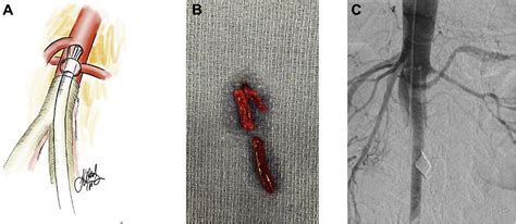 12 Aortobifemoral Bypass Tips For Smoother Recovery