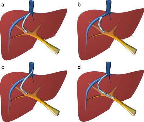 12+ Bile Duct Stent Tips For Reduced Complications