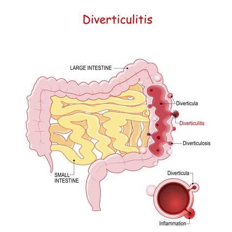 12 Bleeding Diverticular Disease Symptoms To Recognize