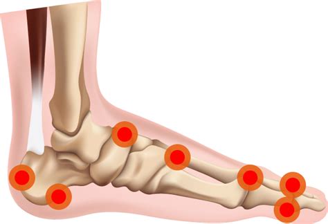 12 Bone Spur Surgery Tips For Faster Recovery