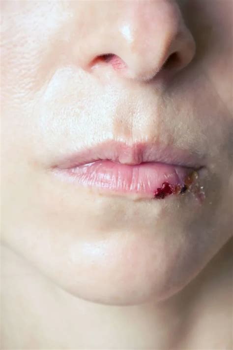 12 Busted Lip Remedies For Fast Healing