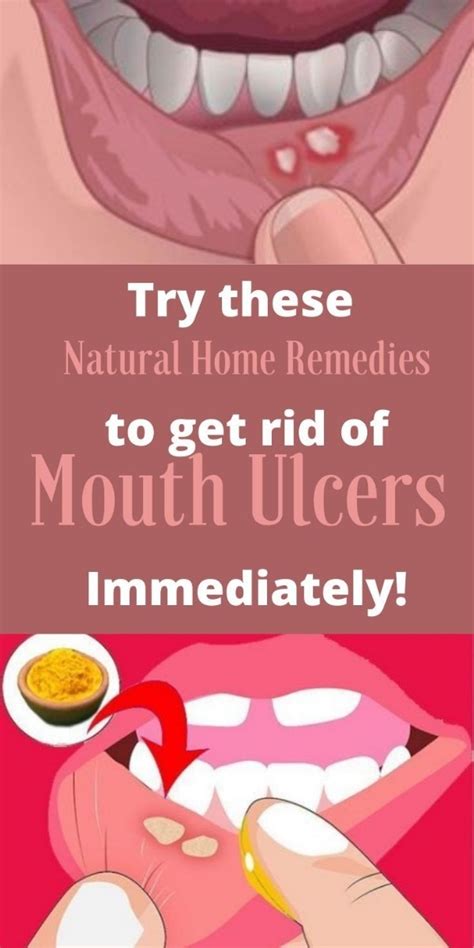 12 Cut Inside Mouth Remedies To Heal Faster