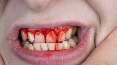 12+ Cut Mouth Healing Tips For Quick Recovery