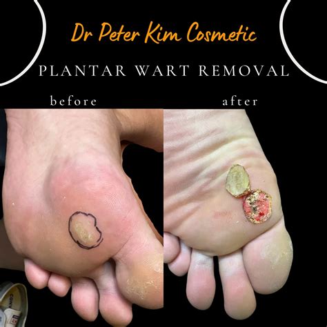 12 Laser Surgery Tips For Wart Removal