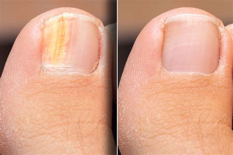 12 Laser Surgery Tips To Cure Toenail Fungus