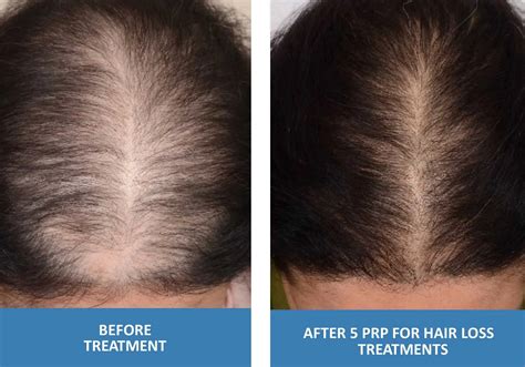 12+ Prp Therapy For Thicker Hair