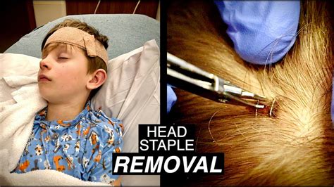 12+ Staples In Head Tips For Safe Removal