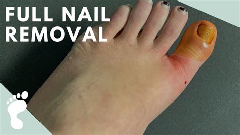 12 Toenail Avulsion Remedies For Fast Healing