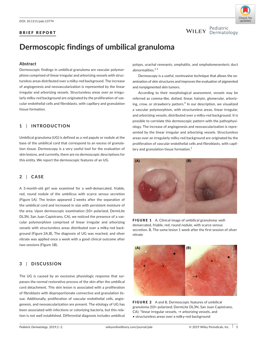 12 Umbilical Granuloma Tips For Faster Healing