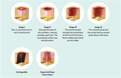 12+ Unstageable Ulcer Tips For Easier Management