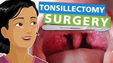 12+ Ways To Reduce Tonsillectomy Pain Quickly