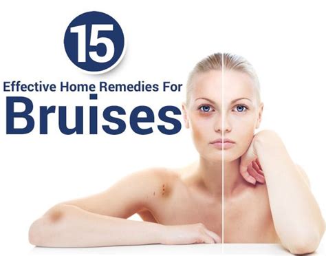 20 Effective Home Remedies For Bruises