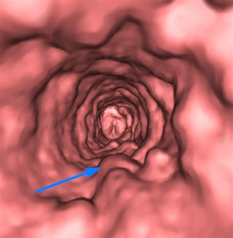 20 Laryngeal Papillomatosis Must See Facts Voice Change Solutions