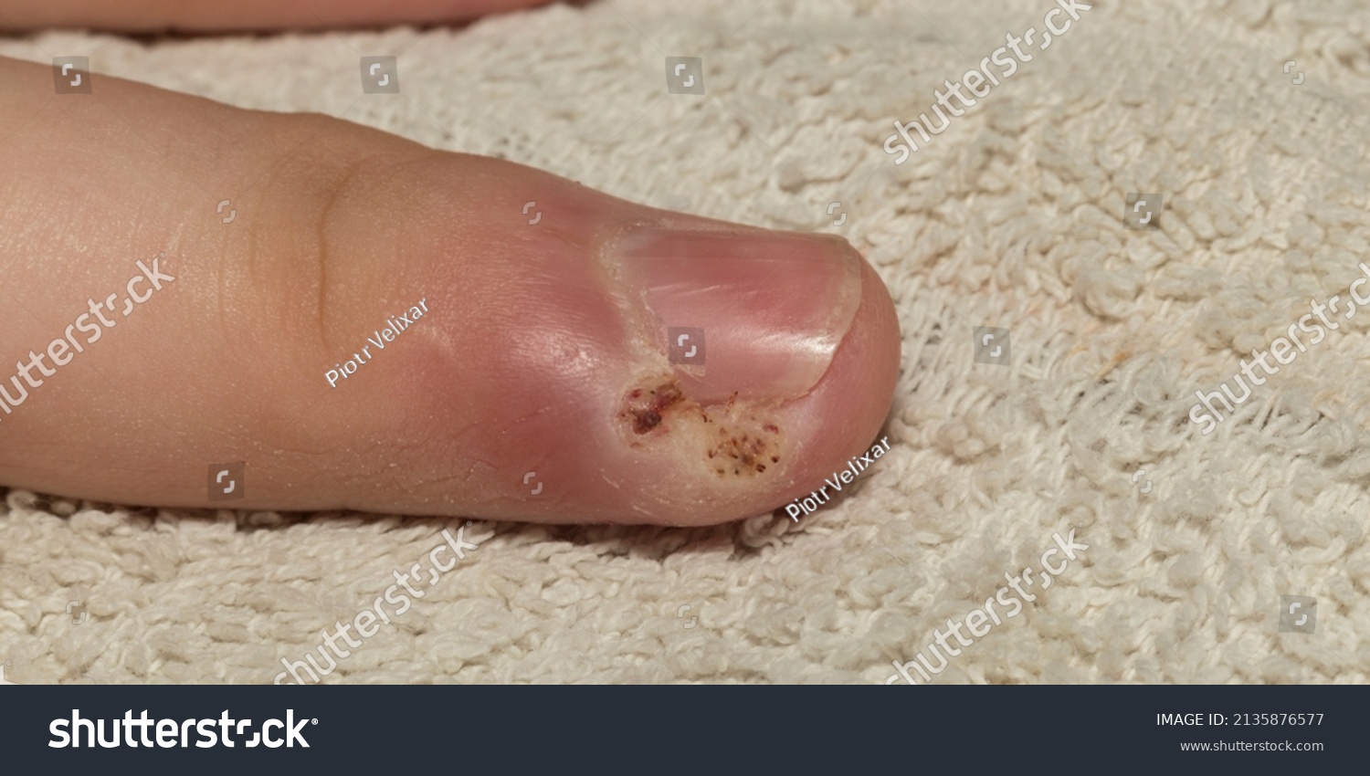 200 Felon Finger Infection Stock Photos Pictures Royalty Free