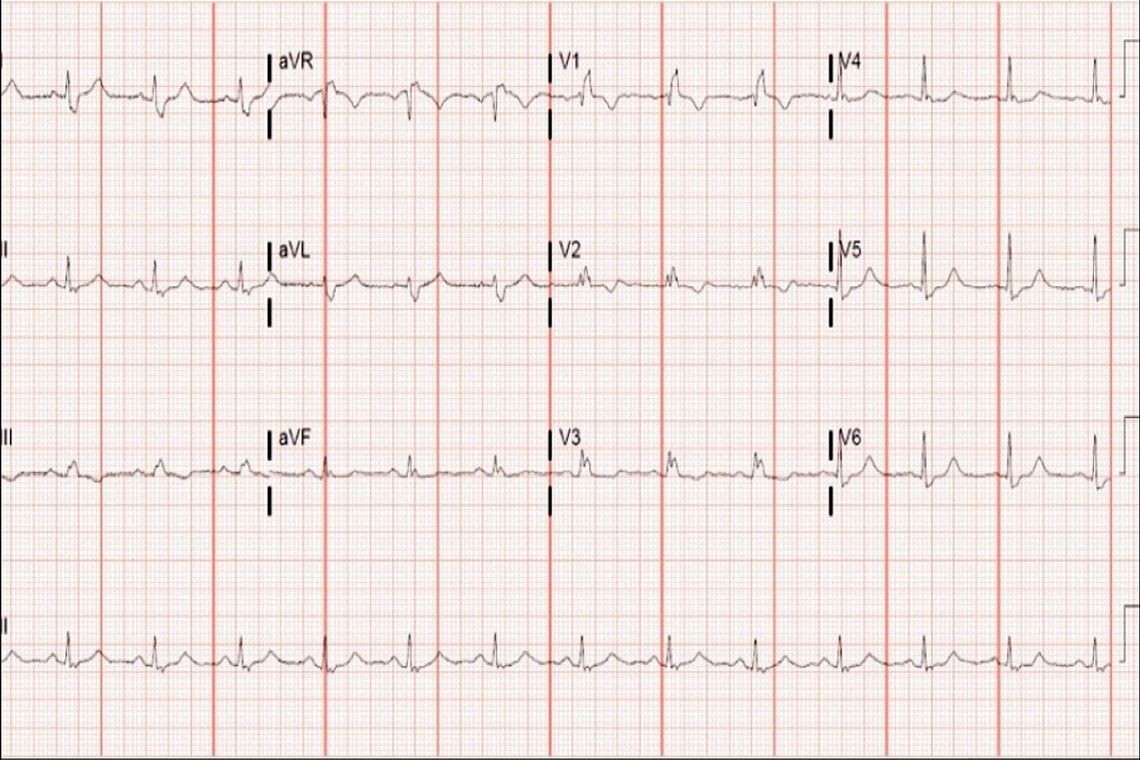 21 Year Old Male With Transient Abnormal Ecg American College Of