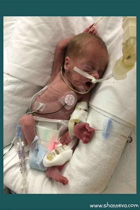 25 Weeks Gestation Meet A Micro Preemie Fighter Named Ephraim Learn