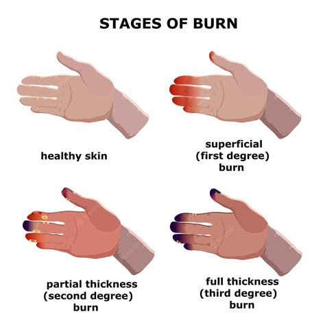 2Nd Degree Burn Treatment Guide: Heal Faster