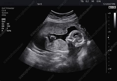 2Nd Trimester Ultrasound