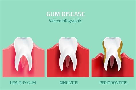 3 Gum Disease Prevention Tips Austin Primary Dental Austin Texas