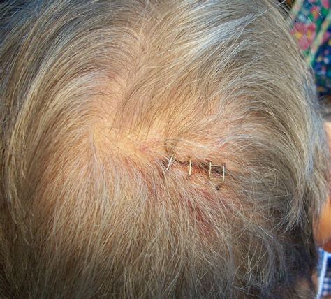 3 Staples In Head