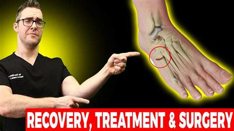 5Th Metatarsal Jones Fracture Recovery Treatment Surgery Youtube