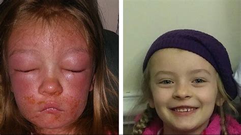 6 Year Old Develops Bacterial Skin Infection After Swimming At Beach