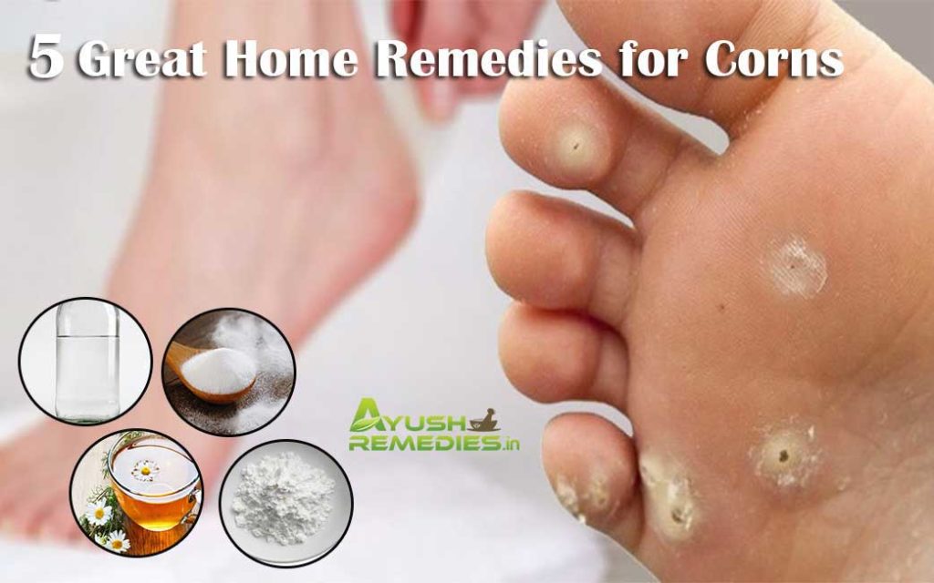 7+ Natural Remedies To Remove Corns Easily