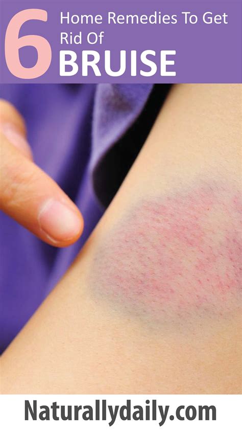 8 Bruise Remedies For Faster Healing