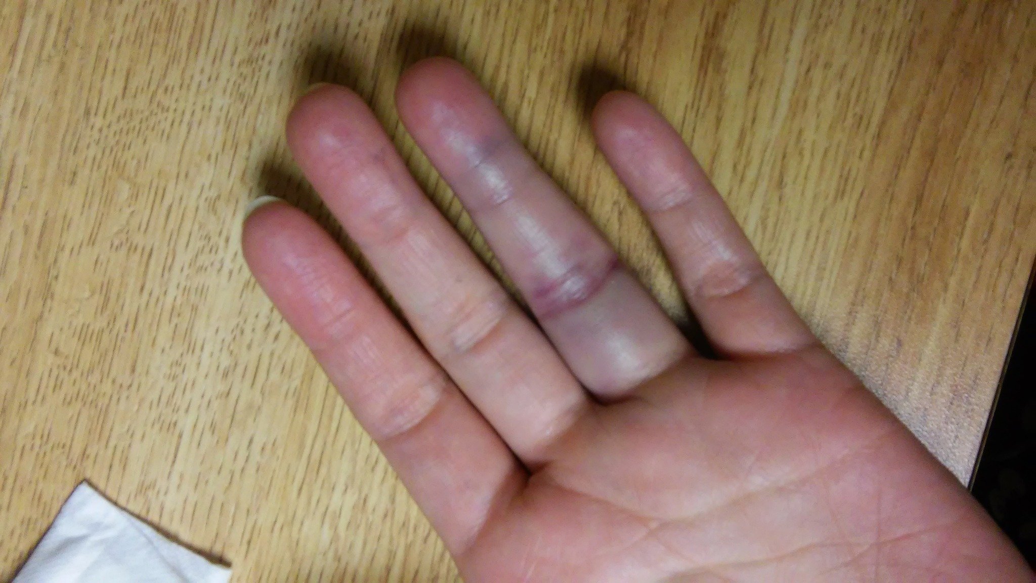 8 Essential Sprained Finger Exercises For Full Recovery