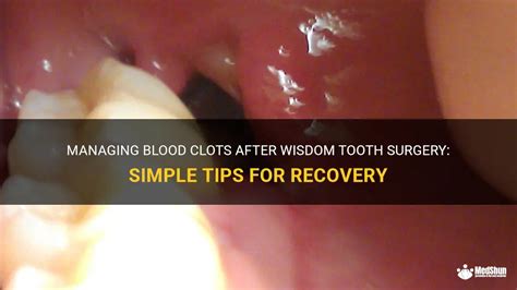 8 Wisdom Teeth Clot Tips For Faster Healing