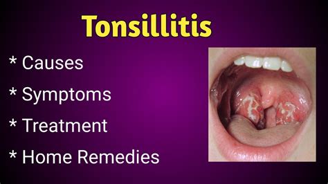 9 Signs And Symptoms Of Tonsillitis Youtube