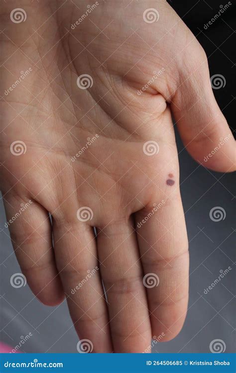 A Flaw In The Skin On The Hand Of The Palm Bruising Bruise Mole Closeup