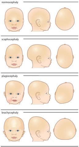 A Guide To Different Head Shapes Craniosacral Therapy Torticollis